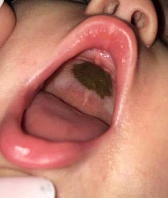 She hurried her daughter to the hospital after noticing a black spot in her daughter’s mouth.