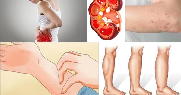 If Your Kidney Is in Risk, Your Body Will Alert You With These 8 Symptoms!