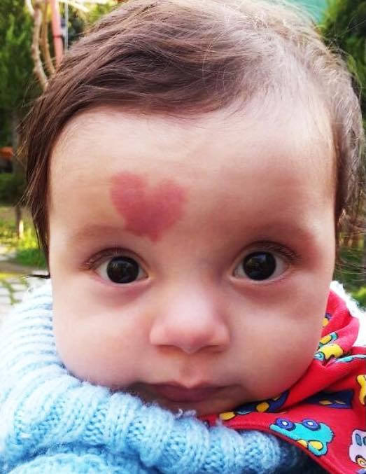 In 2015, a baby born with a ‘heart’ birthmark became internationally renowned; here’s how he looks four years later.