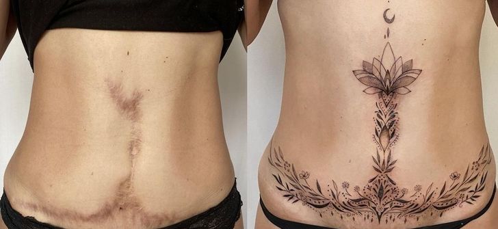 Tattoos can help you change scars into something wonderful