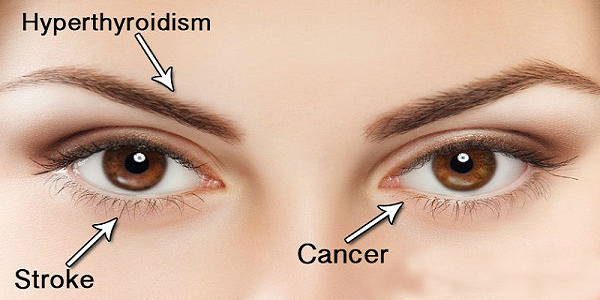 14 Signs That Your Eyes Are Telling You About Your Health (If You Know What Look For)