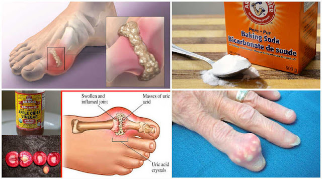 How to Eliminate Uric Acid Crystallization from Your Body Immediately to Avoid Gout and Joint Pain