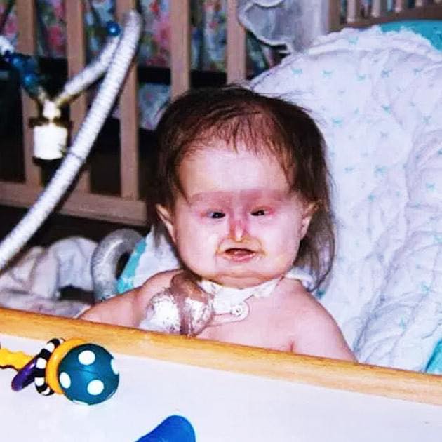 Woman Looks Incredible 25 Years Later After Being Born With An Extraordinary Condition