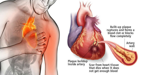 How to Stop a Heart Attack in 60 Seconds With a Common Item in Your Kitchen