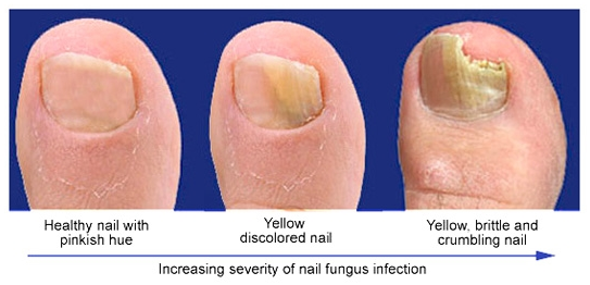 The Risks of Ignoring Fungal Infections in Toe Nails