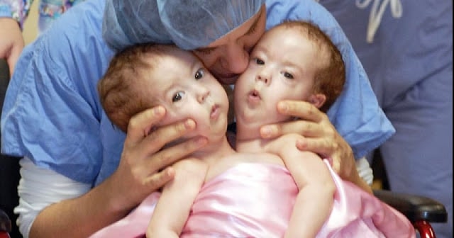 Conjoined twins were joined at the hip from birth, but surgery separated them for good.