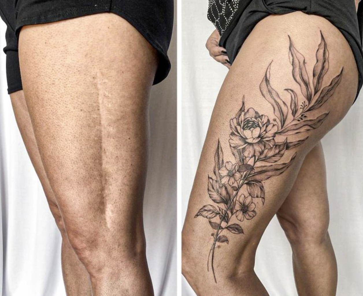 Transforming Scars into Beautiful Tattoos: Inspiring Stories of Resilience