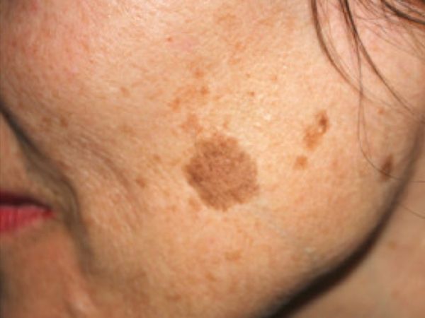 Embracing Your Beautiful Skin: The Miracle of Age Spot Fading